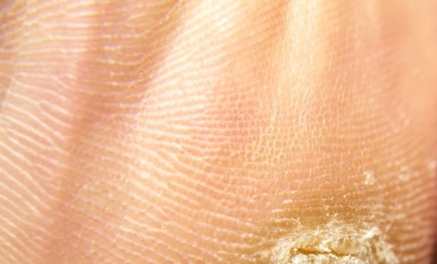 Лечение бородавки на пятке