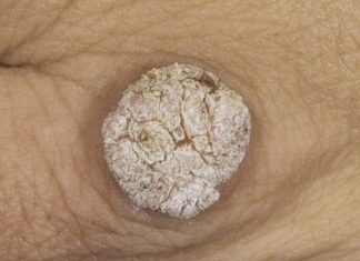 Гель от бородавок «Панавир»