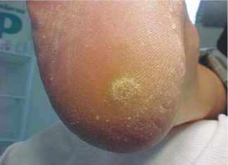 Бородавки на ногах