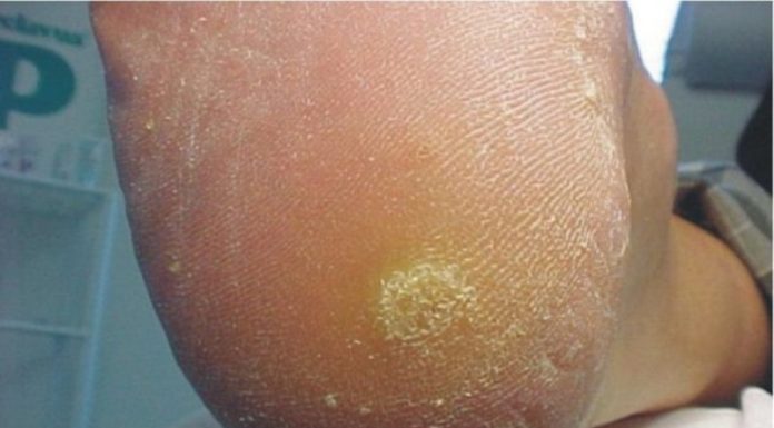 Бородавки на ногах