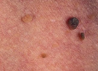 Отличие папиллом от невуса или моллюска