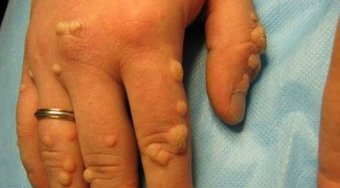 Как убрать бородавку в домашних условиях