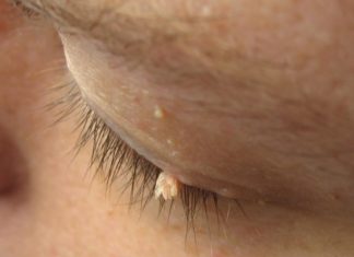 Можно ли перевязывать папиллому волосом либо ниткой?