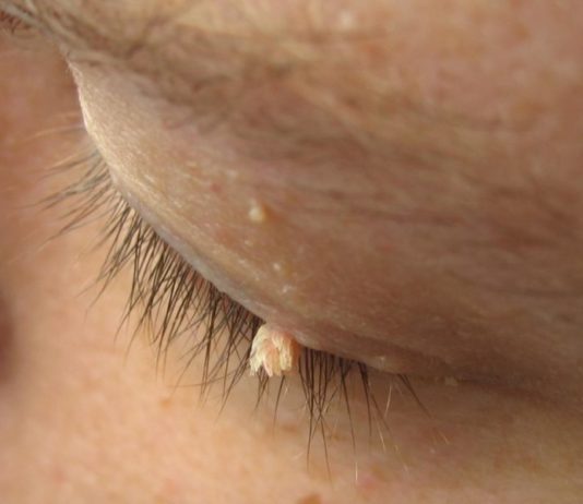 Можно ли перевязывать папиллому волосом либо ниткой?