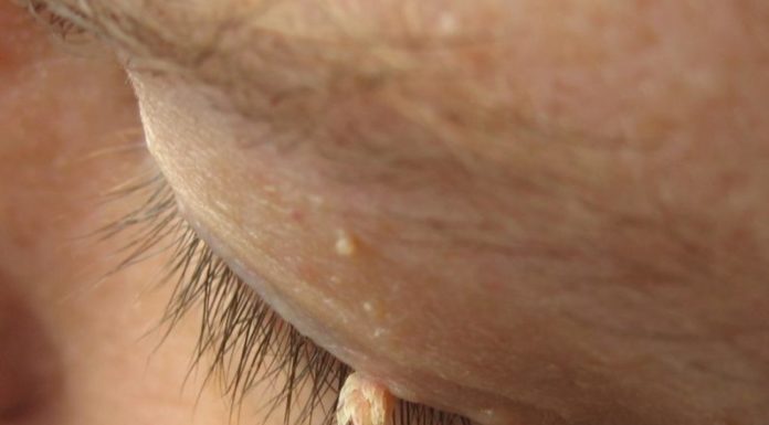 Можно ли перевязывать папиллому волосом либо ниткой?