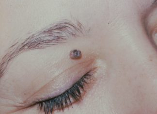 Эфирные масла от папиллом