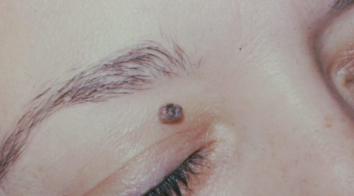 Эфирные масла от папиллом