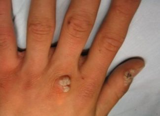 Бородавки на руках. Медикаментозное лечение и народные рецепты