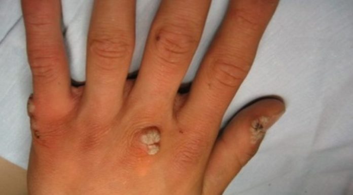 Бородавки на руках. Медикаментозное лечение и народные рецепты