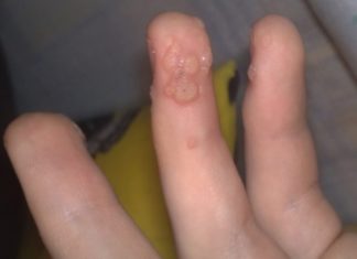 К какому врачу обращаться с бородавками