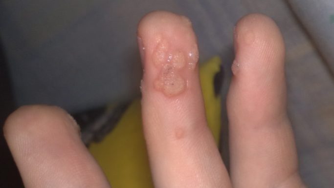 К какому врачу обращаться с бородавками