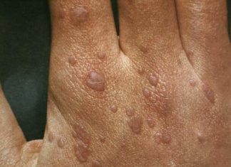 Лечение плоских папиллом