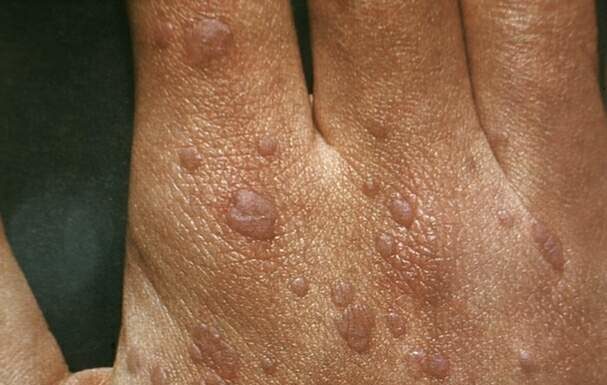 Лечение плоских папиллом