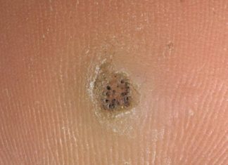 Корень бородавки