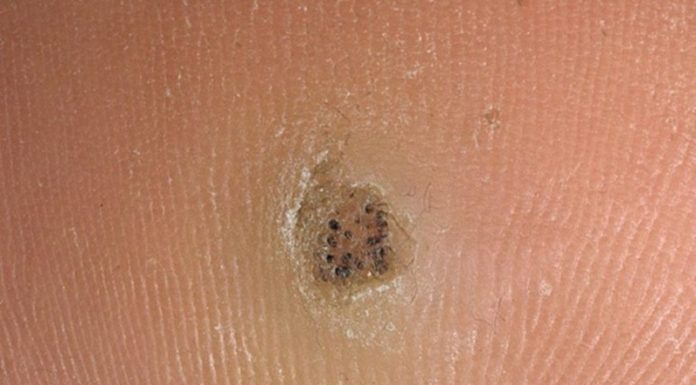 Корень бородавки