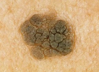 Когда бородавка может перерасти в рак?