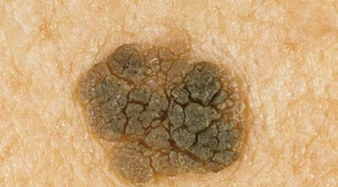 Когда бородавка может перерасти в рак?