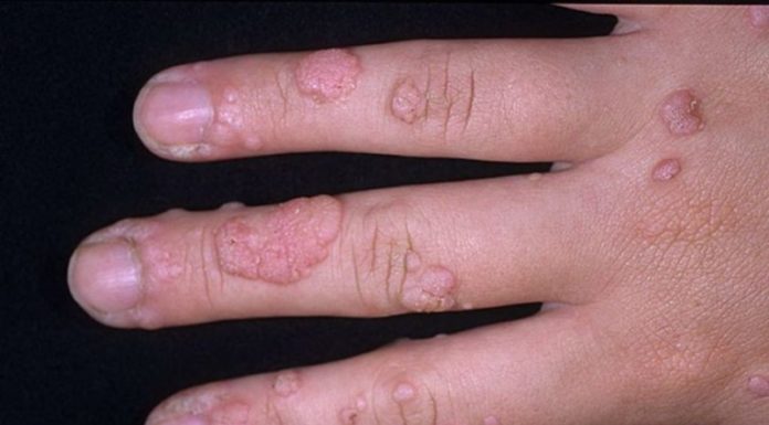 Распознаем виды бородавок на пальцах