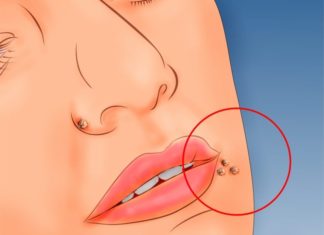 Как вывести бородавку уксусом