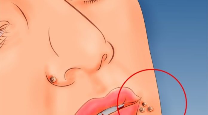 Как вывести бородавку уксусом