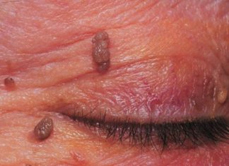 Бородавки на веках и глазах