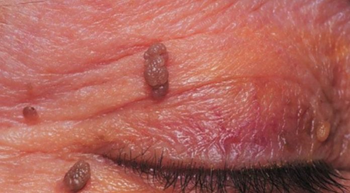 Бородавки на веках и глазах