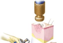 Удаление папиллом жидким азотом