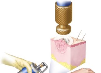 Удаление папиллом жидким азотом