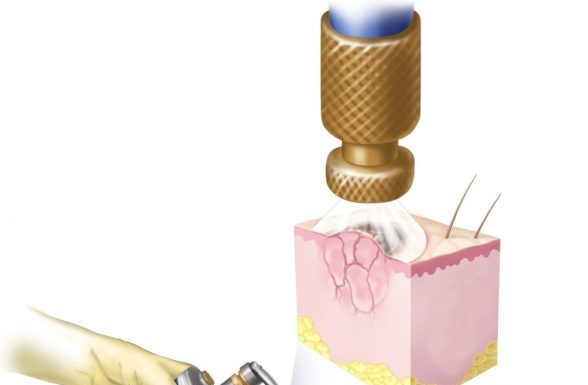 Удаление папиллом жидким азотом