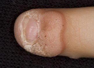 Первые признаки папилломавируса