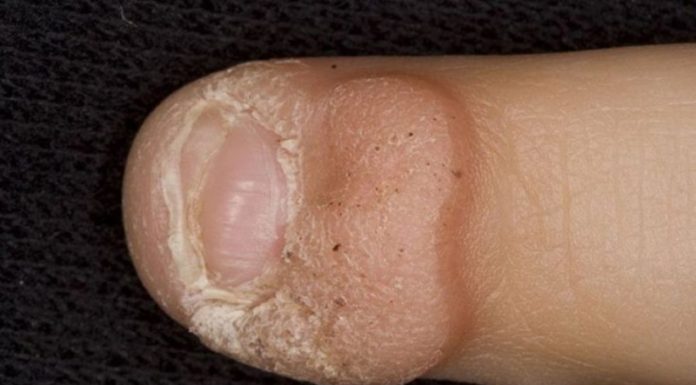 Первые признаки папилломавируса