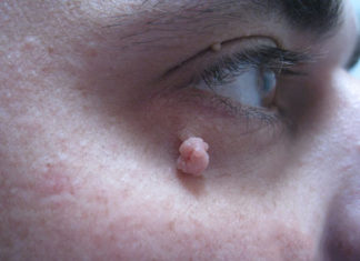 Могут папилломы пропасть без лечения?