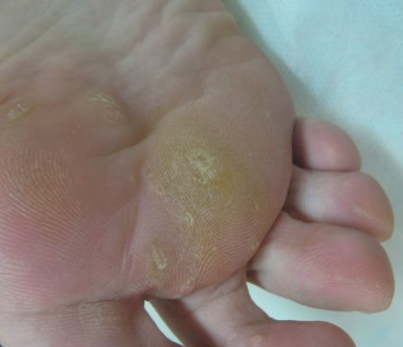 Отличия бородавки на стопе от мозоли