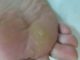 Отличия бородавки на стопе от мозоли