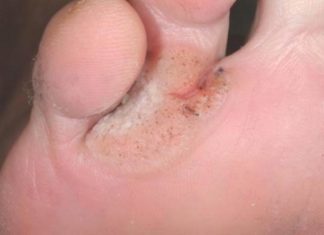 Бородавка на пальце ноги