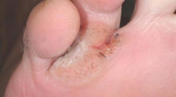 Бородавка на пальце ноги