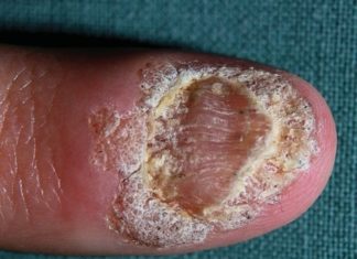 Лечение подногтевых бородавок