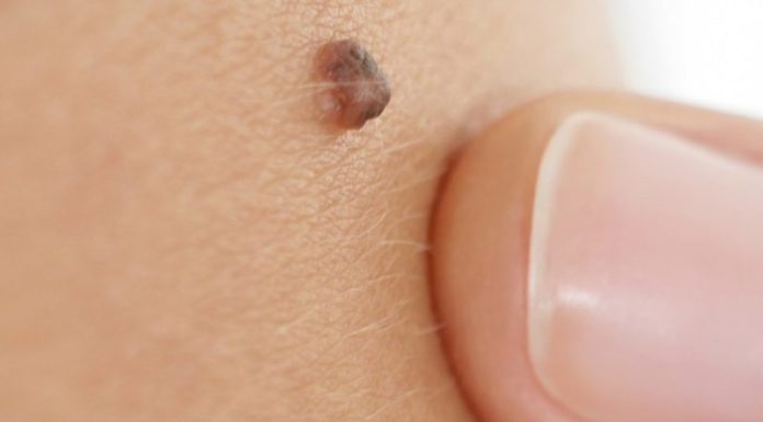 Что будет если случайно повредить папиллому