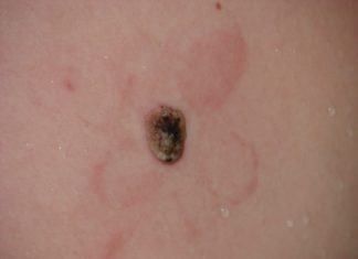 Если папиллома почернела