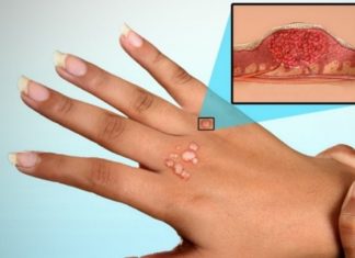 Если растут бородавки