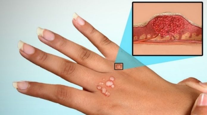 Если растут бородавки