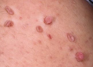 Надо ли удалять папилломы?