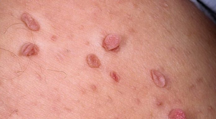 Надо ли удалять папилломы?