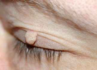 Лечение висячих бородавок