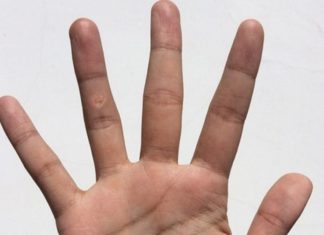 Куриная жопка на руке