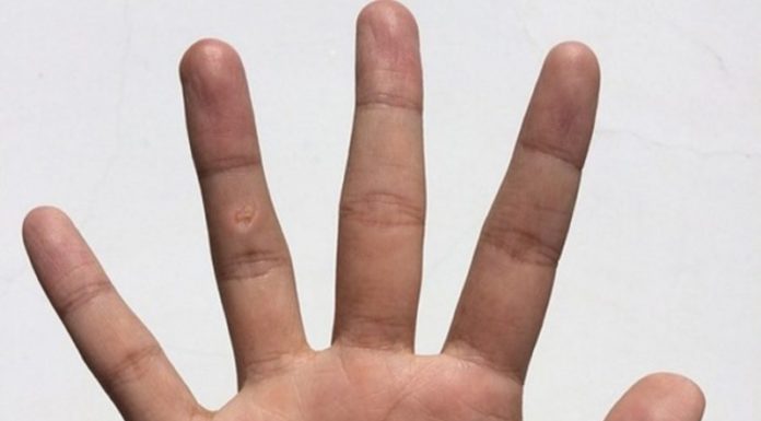 Куриная жопка на руке