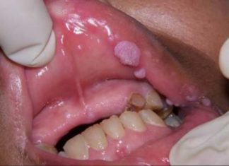 Бородавки во рту