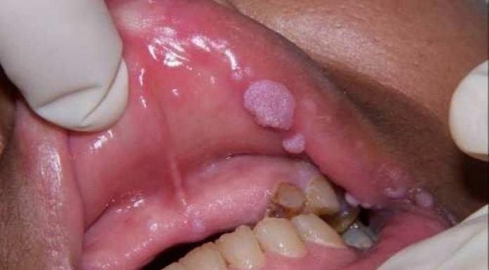 Бородавки во рту