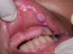 Бородавки во рту