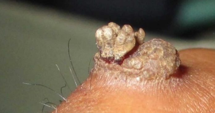 Удаляем большую бородавку